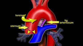 Ligamentum arteriosum and its clinical significance [upl. by Moyra848]