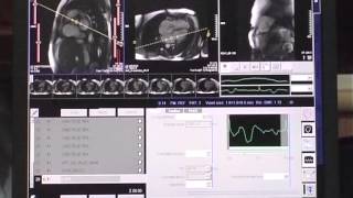 How to perform a cardiac MRI study [upl. by Cornall745]