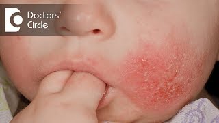 What causes Eczema and Dermatitis  Dr Rajdeep Mysore [upl. by Ruberta]