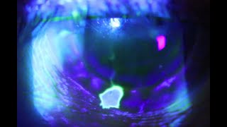 A positive Seidels Test or the corneal waterfall sign [upl. by Hoenack124]