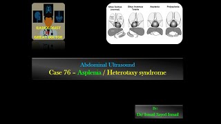 Ultrasound Case 76 Asplenia  Heterotaxy Syndrome [upl. by Doughty34]