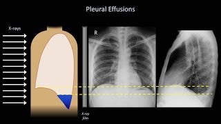 How to Interpret a Chest XRay Lesson 6  Diaphragm and Pleura [upl. by Okiron929]