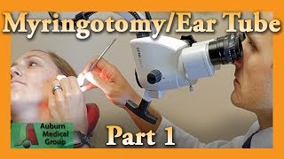 Myringotomy amp Ear Tube Part 1 Feat Dr Tim Fife  Myringotomy  Auburn Medical Group [upl. by Risley]