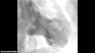 Takotsubo Cardiomyopathy LV Angiography [upl. by Sachiko]