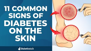 11 Common Signs of Diabetes on The Skin [upl. by Rainwater]