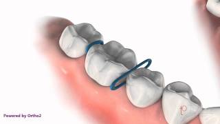 Orthodontic Spacers [upl. by Bren]