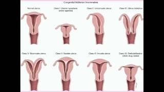 Congenital Uterine Abnormalities  CRASH Medical Review Series [upl. by Casey859]