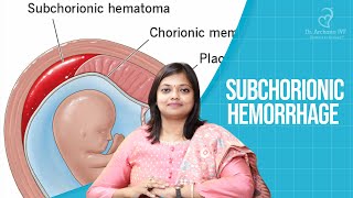 Subchorionic Hemorrhage Dr Archana S Ayyanathan [upl. by Raoul251]