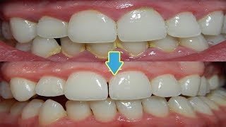 How to Remove Teeth Plaque Naturally at Home Best Remedies for Teeth Plaque Removal [upl. by Etnaid865]