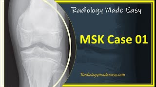 FRCR Radiology MSK Case 01  A 13 yrs old boy presented with pain in the left lower limb [upl. by Aubin411]