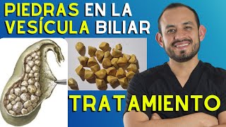 🥑 Síntomas y TRATAMIENTO de las Piedras en la Vesícula Colelitiasis y Colecistitis [upl. by Ateerys471]