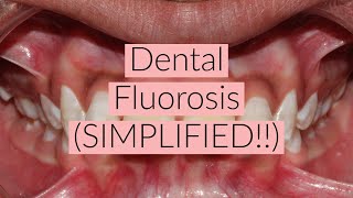 Dental Fluorosis SIMPLIFIED [upl. by Laresa]