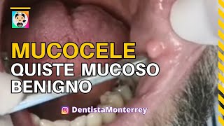 MUCOCELE 👅 QUISTE MUCOSO BENIGNO dental [upl. by Mahgirb757]