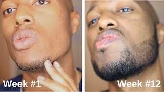 Minoxidil Beard Journey 3 Month Transformation [upl. by Eelram]