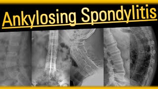 Ankylosing Spondylitis arthritis radiology bones [upl. by Napas]