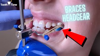 Headgear Braces  Orthodontic Appliance  11 Year old patient  Tooth Time New Braunfels Texas [upl. by Felizio]