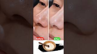 Best home remedy to remove Blackheads amp Whiteheads  How to get rid of pimple on your chin [upl. by Hester]