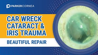 Car Wreck Cataract amp Iris Trauma – Beautiful Repair [upl. by Eneli735]