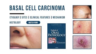 Basal cell carcinoma  Epithelial Pathology  Histology  Etiology  Oral Pathology [upl. by Burman]