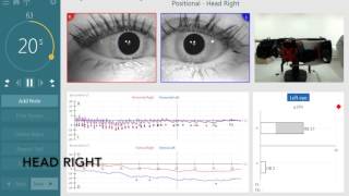 BPPV Assesment with the new TRV Chair by Interacoustics [upl. by Dolly]