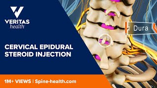 Cervical Epidural Steroid Injection [upl. by Verda]