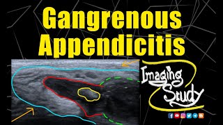 Gangrenous Appendicitis  Ultrasound  Case 211 [upl. by Ynnus772]