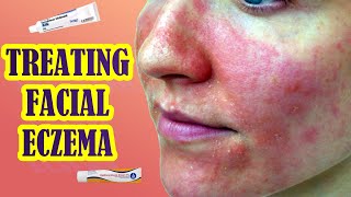 Effective Treatments For Eczema On The Face  Topical Steroids or Tacrolimus [upl. by Yolane]