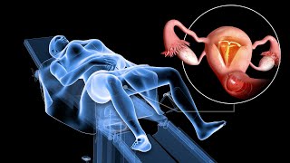 Mirena IUD After Menopause  Is it the same as Progesterone [upl. by Feeley]