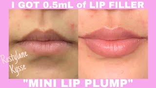 GETTING LIP FILLER FOR THE FIRST TIME  05mL Restylane Kysse mini lip filler [upl. by Brandtr]