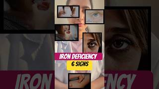 Iron deficiency signs health shorts youtubeshorts subscribe trending shortvideo shortsfeed [upl. by Outhe503]