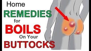 The 3 Most Effective Home REMEDIES for BOILS on BUTTOCKS  Boils BUTTOCKS Treatment for Fast Relief [upl. by Ayeka]