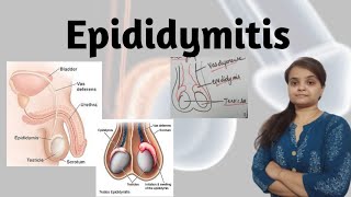 Epididymitis [upl. by Nolyaj]