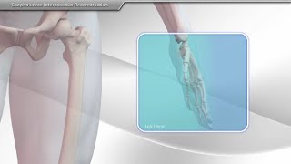 Scapholunate Ligament Reconstruction [upl. by Aneekat]