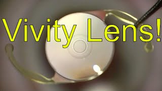 VIVITY lens for cataract surgery  Mechanism of Action  Dr Simon Chen [upl. by Montagna]