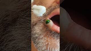 blackheads spa doctor pimpleremoval [upl. by Aicirtel]