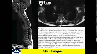 Syrinx spinal cord cyst [upl. by Yale]