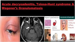 Acute dacryoadenitis Tolosa–Hunt syndrome amp Wegeners Granulomatosis kanskiseries 2022 2023 [upl. by Aerdnahs338]