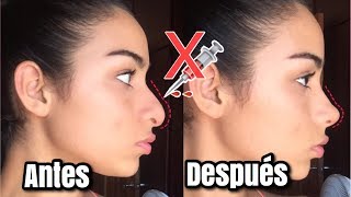 RINOPLASTIA CASERA EN MINUTOS  RESPINGADORES PARA NARIZ BONITA [upl. by Nerag29]