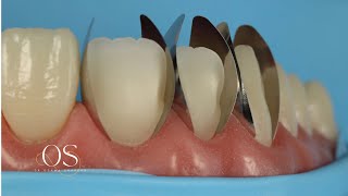 Direct veneering using composite resin with new unica proximal matrix the simplified approach [upl. by Oniluap884]