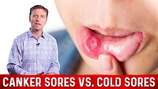 Canker Sores Vs Cold Sores – Dr Berg on Mouth Sores [upl. by Yelyak]