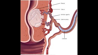 Uterine Adenomyosis  Diagnosis amp Treatment [upl. by Eydnarb]