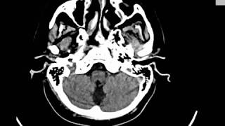 CASE 348 CT BRAIN LACUNAR AND BASAL GANGLIA INFARCTION ATROPHIC CHANGES [upl. by Ahsenav]