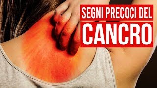 10 Segni Precoci Del Cancro Che La Maggior Parte Delle Persone Ignora [upl. by Oinesra]