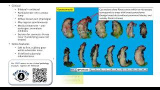 Breast Male Gynaecomastia Gross pathology [upl. by Arnelle539]