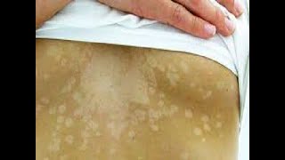 Tinea Versicolor Fungal infection Sehua का सही इलाज। Dr Sandesh Gupta Dermatologist [upl. by Ardaed]