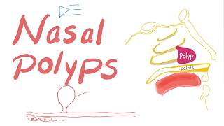 Nasal Polyps Allergic Rhinitis and Cystic Fibrosis [upl. by Peyter]