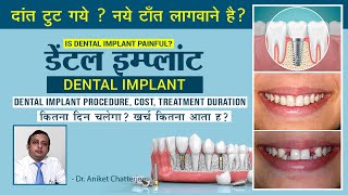 Dental Implant in Hindi  Cost  Procedure amp Duration  डेंटल इम्प्लांट  कीमत प्रक्रिया और समय [upl. by Eiuqnom256]