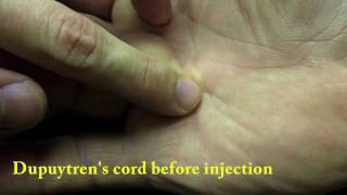 Xiaflex collagenase injection for Dupuytrens Finger Contracture [upl. by Nnairrek]