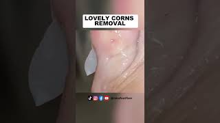 lovely Corns removal from toe  Miss Foot Fixer [upl. by Rahab]