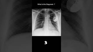 Implantable cardioverter defibrillator 164 Cardiac disease chest xray Quiz radiologychannel007 [upl. by Eserrehs248]